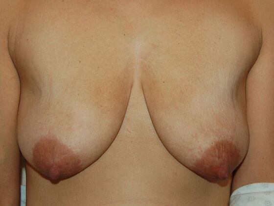 Breast Augmentation w/ Lift Case 35 - Before