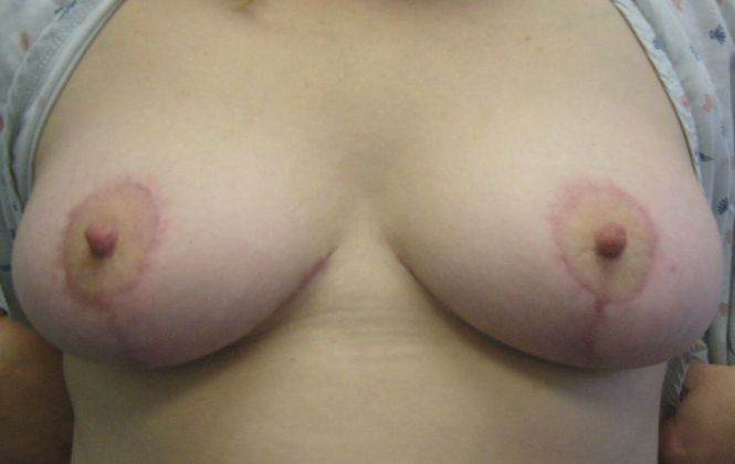 Breast Lift (Mastopexy) Case 1 - After