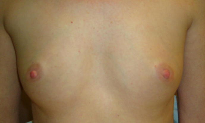 Breast Augmentation Case 808 - Before