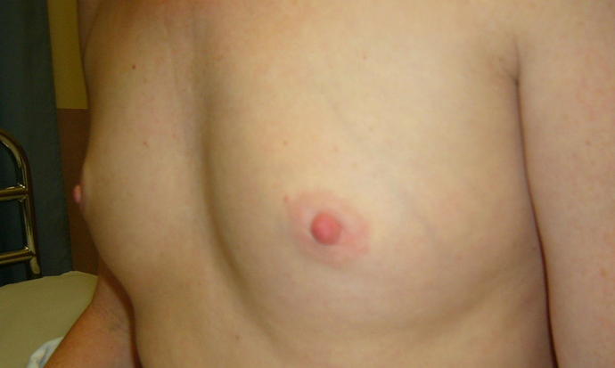 Breast Augmentation: Case 808 - Before Breast Augmentation