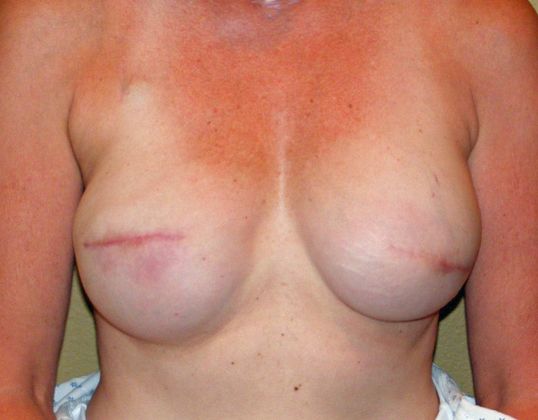 Breast Reconstruction Case 6 - After