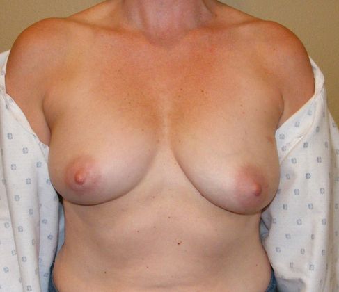 Breast Reconstruction Case 6 - Before