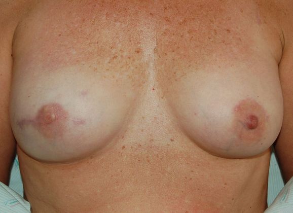 Breast Reconstruction Case 8 - After
