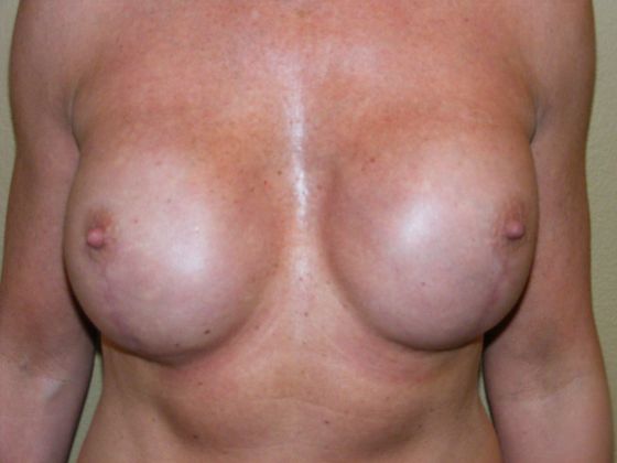 Breast Reconstruction Case 9 - After