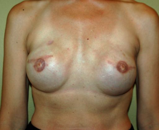 Breast Reconstruction Case 10 - After