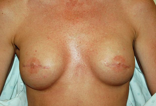 Breast Reconstruction Case 11 - After