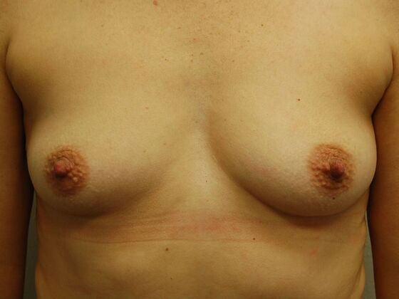 Breast Augmentation: Case 38 - Before Breast Augmentation