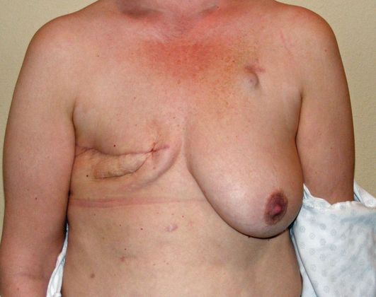 Breast Reconstruction Case 13 - Before