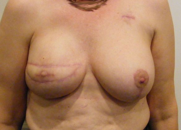 Breast Reconstruction Case 13 - After