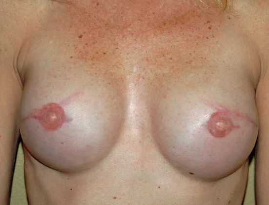 Breast Reconstruction Case 14 - After