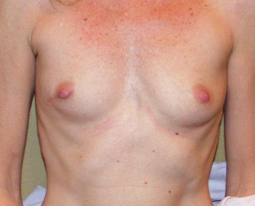 Breast Reconstruction Case 14 - Before