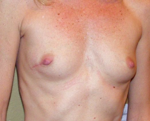 Breast Reconstruction: Case 14 - Breast Reconstruction Before