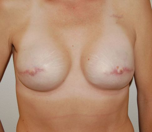 Breast Reconstruction Case 15 - After