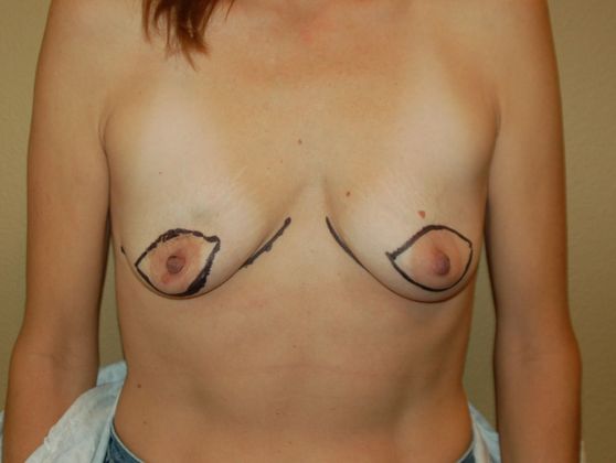 Breast Reconstruction Case 15 - Before