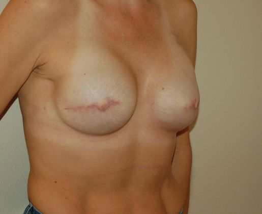 Breast Reconstruction: Case 15 - Breast Reconstruction After