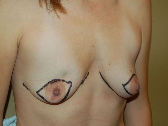 Breast Reconstruction: Case 15 - Breast Reconstruction Before