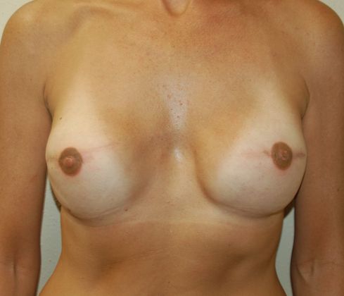 Breast Reconstruction Case 1 - After