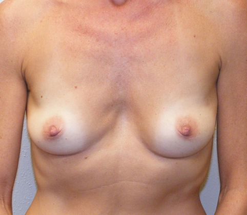 Breast Reconstruction Case 1 - Before