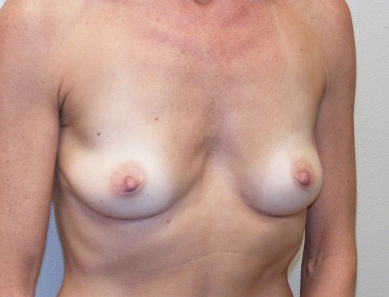 Breast Reconstruction: Case 1 - Breast Reconstruction Before