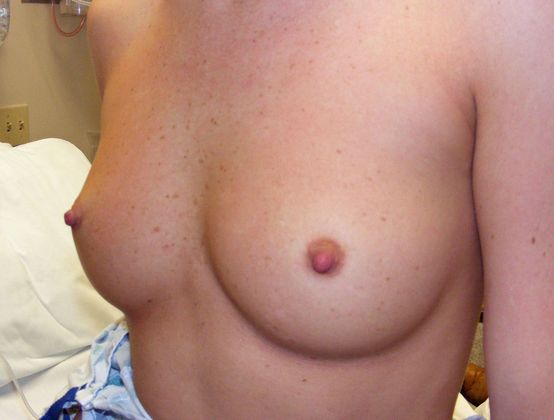 Breast Augmentation: Case 40 - Before Breast Augmentation