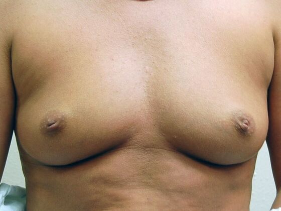 Breast Augmentation: Case 42 - Before Breast Augmentation