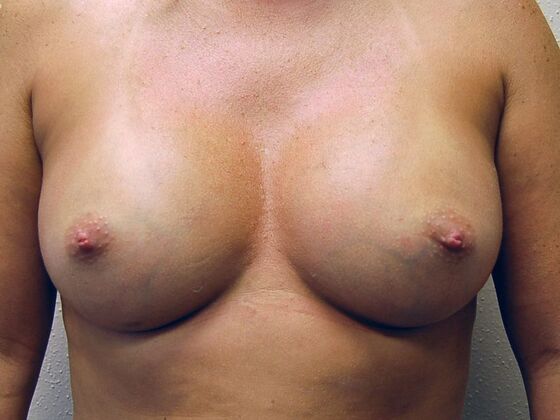 Breast Augmentation: Case 42 - After Breast Augmentation