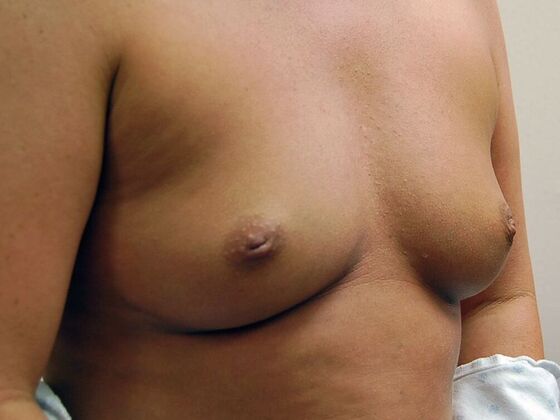 Breast Augmentation: Case 42 - Before Breast Augmentation