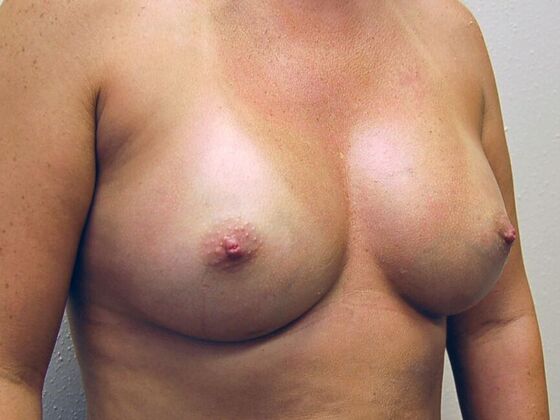 Breast Augmentation: Case 42 - After Breast Augmentation