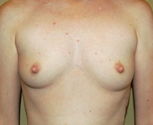 Breast Augmentation Case 48 - Before