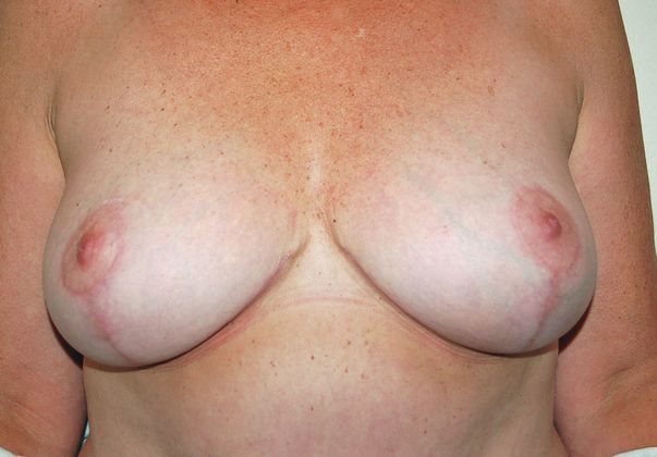 Breast Reduction Case 3 - After