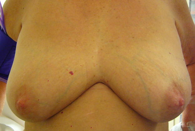 Breast Reduction Case 4 - Before