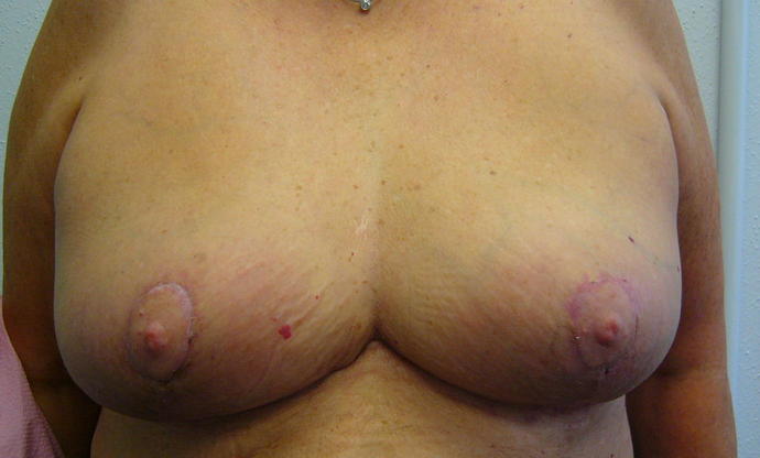Breast Reduction Case 4 - After