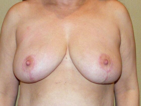 Breast Reduction: Case 5 - Breast Reduction After