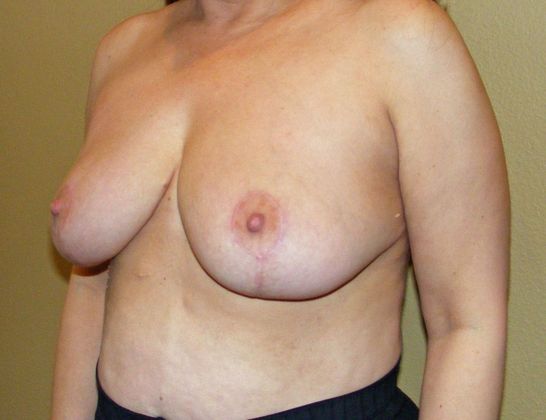 Breast Reduction: Case 5 - Breast Reduction After