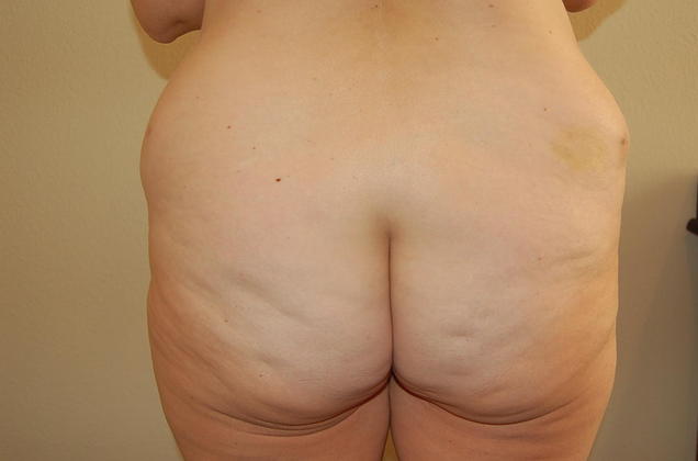 Buttock Lift Case 1 - Before