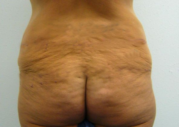 Buttock Lift Case 2 - Before