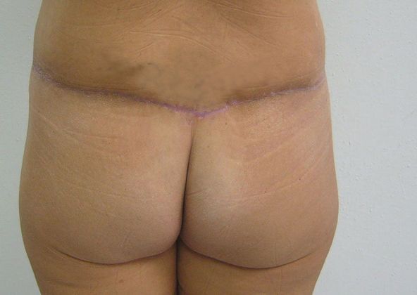 Buttock Lift Case 2 - After
