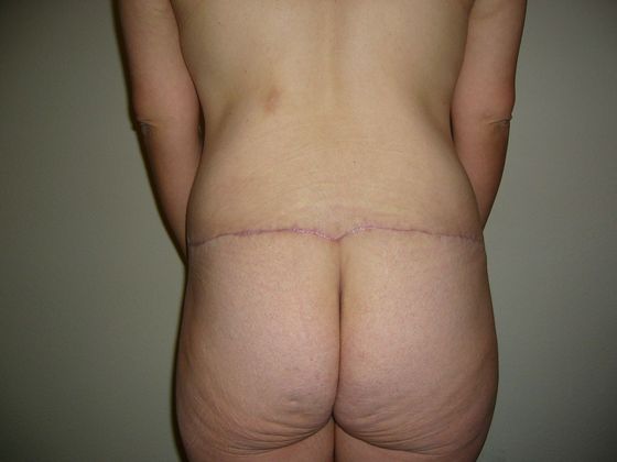 Buttock Lift Case 3 - After
