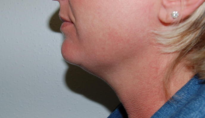 Liposuction Case 1 - Before