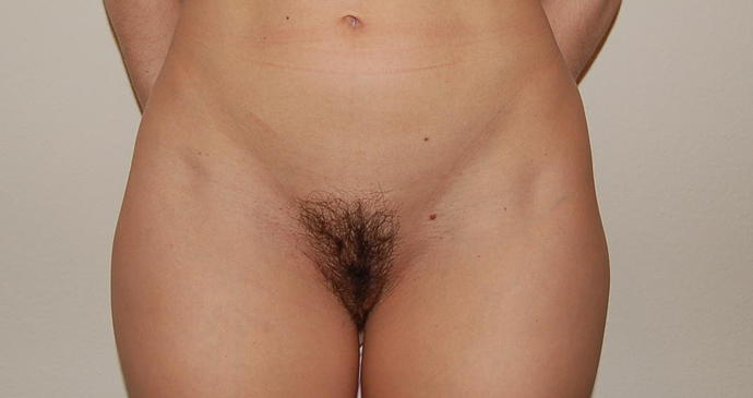 Liposuction Case 2 - Before