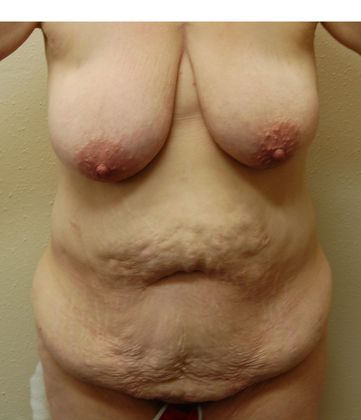 Massive Weight Loss  Case 11 - Before