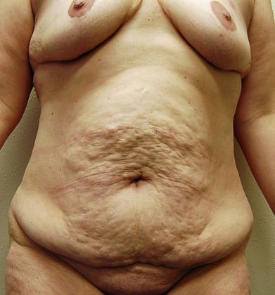 Massive Weight Loss : Case 3 - Massive Weight Loss Before