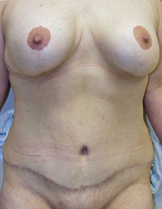 Massive Weight Loss : Case 3 - Massive Weight Loss After