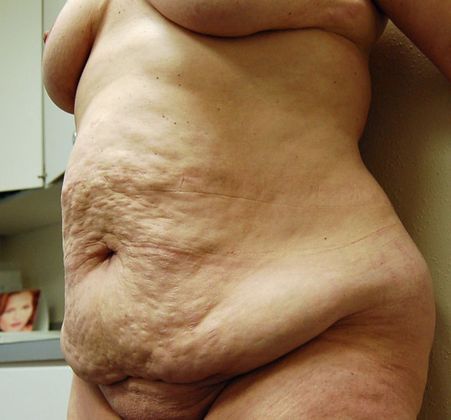 Massive Weight Loss : Case 3 - Massive Weight Loss Before