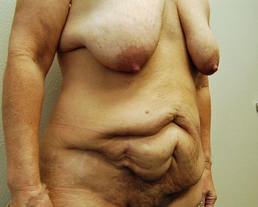 Massive Weight Loss : Case 158 - Massive Weight Loss Before