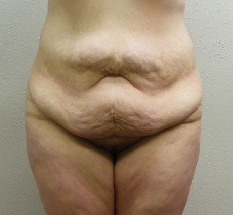 Massive Weight Loss  Case 5 - Before