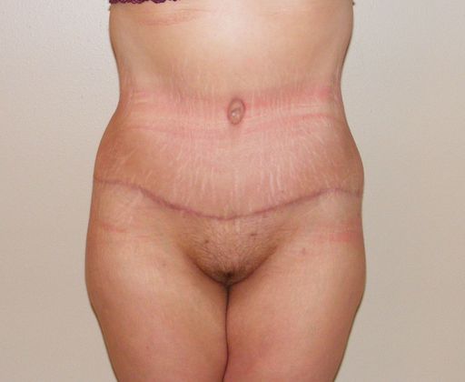 Massive Weight Loss  Case 5 - After