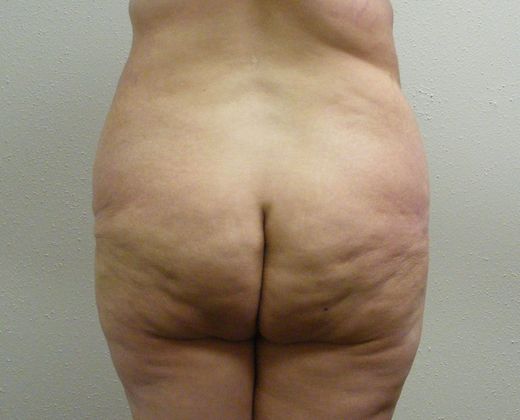 Massive Weight Loss : Case 5 - Massive Weight Loss Before