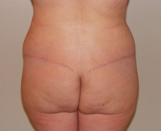 Massive Weight Loss : Case 5 - Massive Weight Loss After