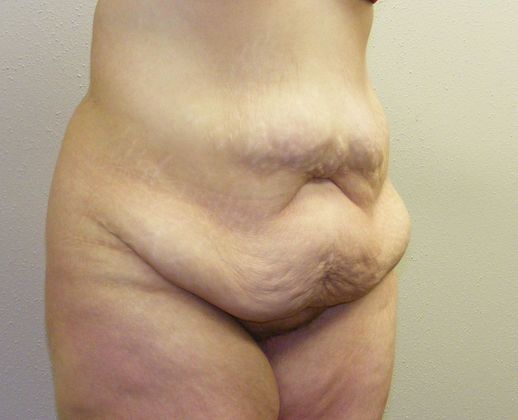 Massive Weight Loss : Case 5 - Massive Weight Loss Before